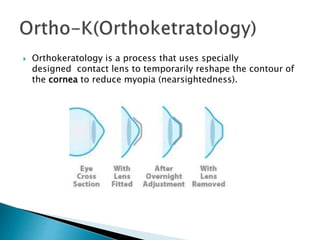  Orthokeratology is a process that uses specially
designed contact lens to temporarily reshape the contour of
the cornea to reduce myopia (nearsightedness).
 