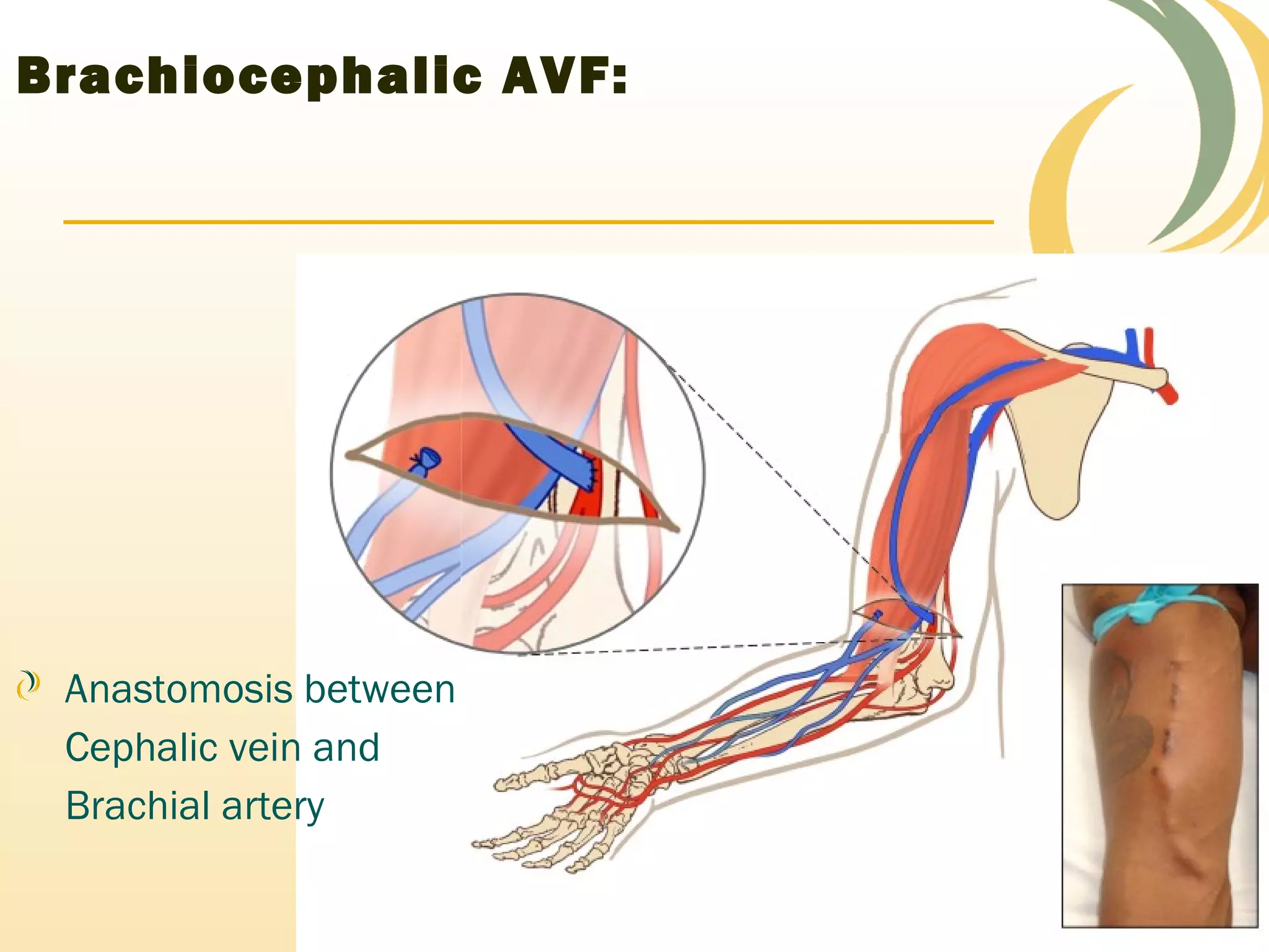 vascular access for dialysis access: seminar | PPT