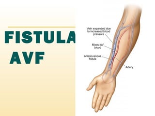 FISTULA/
AVF
 