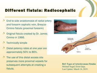 Different fistula: Radiocephalic
End to side anastomosis of radial artery
and forearm cephalic vein, Brescia-
Cimino fistula (proximal forearm)
Original fistula created by Dr. James
Cimino in 1966.
Technically simple
Distal patency rates at one year are
approximately 50% to 80%.
The use of this distal access site
preserves more proximal vessels for
subsequent attempts at creating a
fistula.
Ref: Types of Arteriovenous Fistulas
Michael Segal; Erion Qaja.
Last Update: March 16, 2019.
 