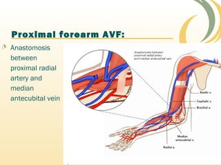 Proximal forearm AVF:
Anastomosis
between
proximal radial
artery and
median
antecubital vein
 