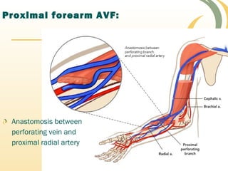 Proximal forearm AVF:
Anastomosis between
perforating vein and
proximal radial artery
 