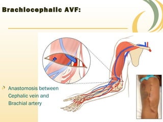 Brachiocephalic AVF:
Anastomosis between
Cephalic vein and
Brachial artery
 