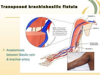 Transposed brachiobasilic fistula
Anastomosis
between Basilic vein
& brachial artery
 