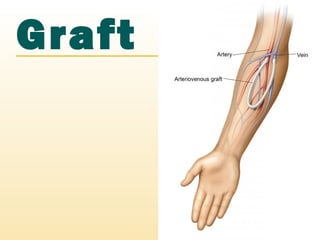 Graft
 