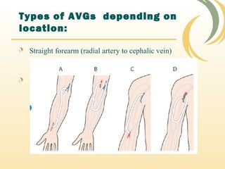 Types of AVGs depending on
location:
Straight forearm (radial artery to cephalic vein)
 