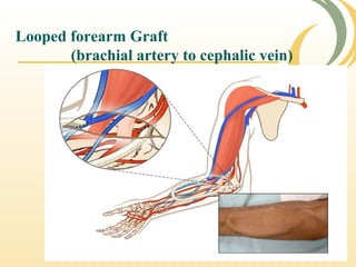 Looped forearm Graft
(brachial artery to cephalic vein)
 