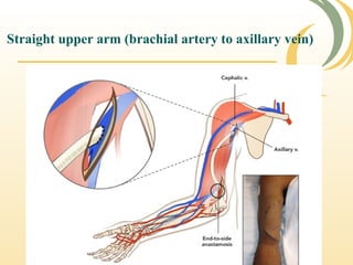Straight upper arm (brachial artery to axillary vein)
 