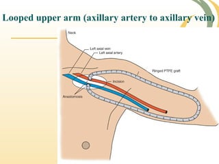 Looped upper arm (axillary artery to axillary vein)
 