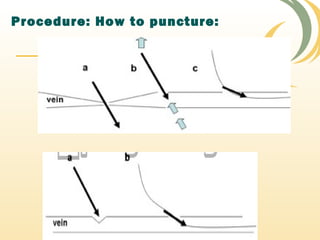 Procedure: How to puncture:
 