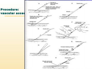 Procedure:
vascular access
 