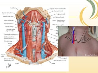 Anatomical consideration
Internal jugular vein
 