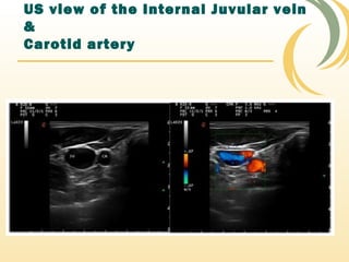 US view of the Internal Juvular vein
&
Carotid artery
 