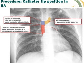 Procedure: Catheter tip position in
RA
 