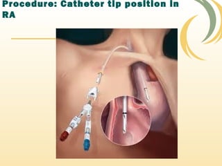 Procedure: Catheter tip position in
RA
 