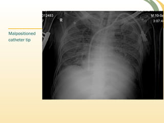 Malpositioned
catheter tip
 