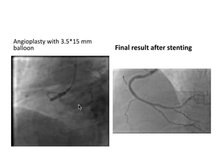Angioplasty with 3.5*15 mm
balloon Final result after stenting
 