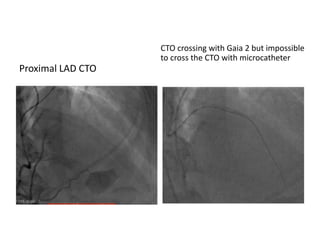Proximal LAD CTO
CTO crossing with Gaia 2 but impossible
to cross the CTO with microcatheter
 