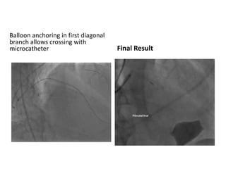Balloon anchoring in first diagonal
branch allows crossing with
microcatheter Final Result
 
