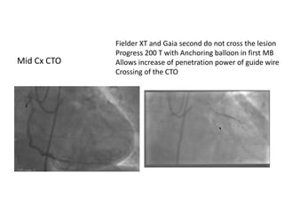 Mid Cx CTO
Fielder XT and Gaia second do not cross the lesion
Progress 200 T with Anchoring balloon in first MB
Allows increase of penetration power of guide wire
Crossing of the CTO
 