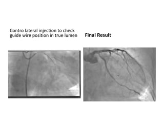 Contro lateral injection to check
guide wire position in true lumen Final Result
 