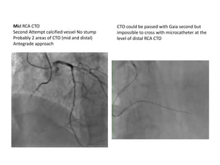 CTO could be passed with Gaia second but
impossible to cross with microcatheter at the
level of distal RCA CTO
Mid RCA CTO
Second Attempt calcified vessel No stump
Probably 2 areas of CTO (mid and distal)
Antegrade approach
 
