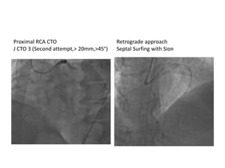 Proximal RCA CTO
J CTO 3 (Second attempt,> 20mm,>45°)
Retrograde approach
Septal Surfing with Sion
 