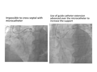 Impossible to cross septal with
microcatheter
Use of guide catheter extension
advanced over the microcatheter to
increase the support
 