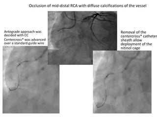 Antegrade approach was
decided with CC
Centercross* was advanced
over a standard guide wire
Removal of the
centercross* catheter
sheath allow
deployment of the
nitinol cage
Occlusion of mid-distal RCA with diffuse calcifications of the vessel
 