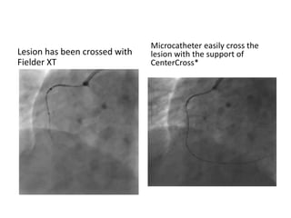 Lesion has been crossed with
Fielder XT
Microcatheter easily cross the
lesion with the support of
CenterCross*
 