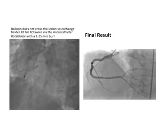 Balloon does not cross the lesion so exchange
fielder XT for Rotawire via the microcatheter
Rotablator with a 1.25 mm burr Final Result
 