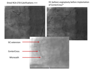CenterCross
Microcath
GC extension
Distal RCA CTO Calcifications +++ D1 balloon angioplasty before implantation
of CenterCross*
 