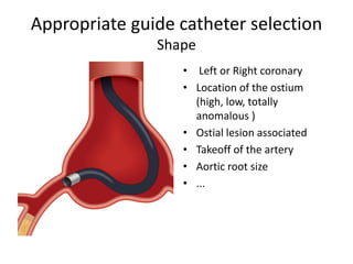 Appropriate guide catheter selection
Shape
• Left or Right coronary
• Location of the ostium
(high, low, totally
anomalous )
• Ostial lesion associated
• Takeoff of the artery
• Aortic root size
• ...
 