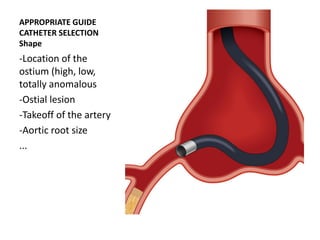 APPROPRIATE GUIDE
CATHETER SELECTION
Shape
-Location of the
ostium (high, low,
totally anomalous
-Ostial lesion
-Takeoff of the artery
-Aortic root size
...
 
