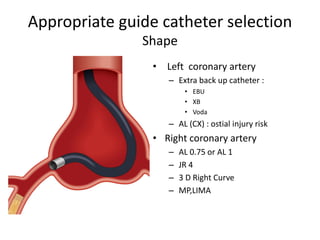 Appropriate guide catheter selection
Shape
• Left coronary artery
– Extra back up catheter :
• EBU
• XB
• Voda
– AL (CX) : ostial injury risk
• Right coronary artery
– AL 0.75 or AL 1
– JR 4
– 3 D Right Curve
– MP,LIMA
 