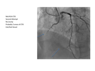 Mid RCA CTO
Second Attempt
No stump
Probably 2 areas of CTO
Calcified Vessel
 