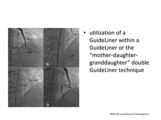 • utilization of a
GuideLiner within a
GuideLiner or the
“mother-daughter-
granddaughter” double
GuideLiner technique
With the courtesy of D Karmpaliotis
 