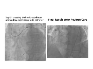 Septal crossing with microcatheter
allowed by extension guide catheter Final Result after Reverse Cart
 