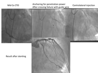 Mid Cx CTO Anchoring for penetration power
After crossing failure with guide wire
Controlateral injection
Result after stenting
 