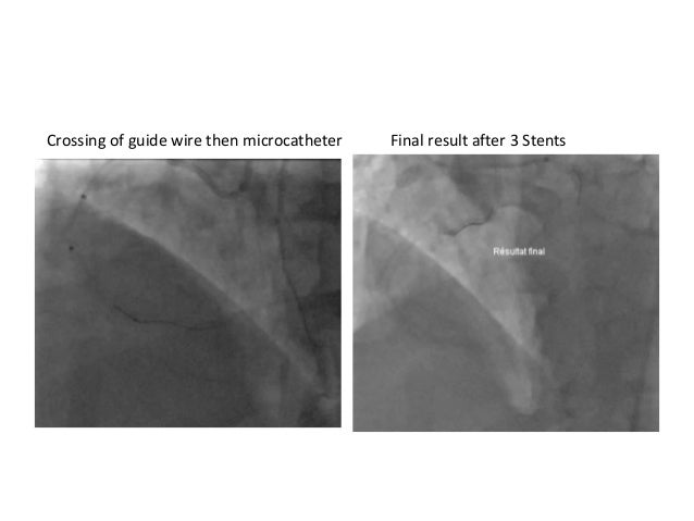 guideliner catheter ppt guideliner catheter ppt
