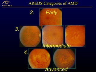 Results from the Age-Related Eye Disease Study2 (AREDS2) | PPT