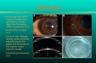 Cornea and Lens Histopathology Refractive Surgery Cataracts High Myopia ...