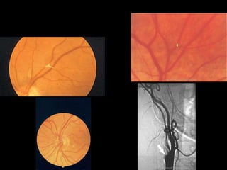 Transient Visual Desaturation Transient visual loss localization and visual field interpretation | PPT