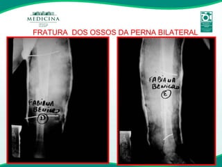 FRATURA  DOS OSSOS DA PERNA BILATERAL 