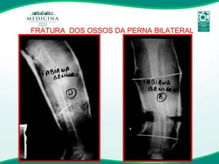 FRATURA  DOS OSSOS DA PERNA BILATERAL 
