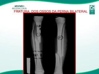 FRATURA  DOS OSSOS DA PERNA BILATERAL 
