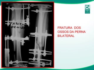 FRATURA  DOS OSSOS DA PERNA BILATERAL 