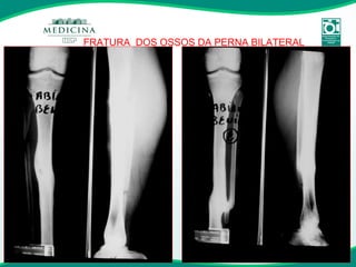 FRATURA  DOS OSSOS DA PERNA BILATERAL 