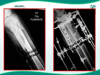 YF 72a FUMANTE 