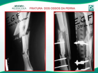 FRATURA  DOS OSSOS DA PERNA 